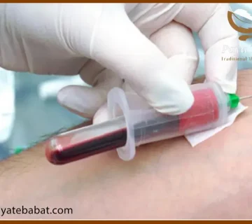 فصد خون برای غلظت خون